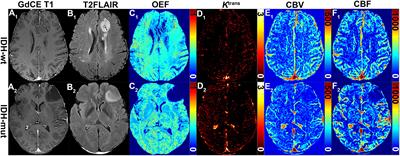 Application of Cluster Analysis of Time Evolution for Magnetic Resonance Imaging -Derived Oxygen Extraction Fraction Mapping: A Promising Strategy for the Genetic Profile Prediction and Grading of Glioma